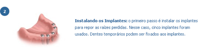 implante5